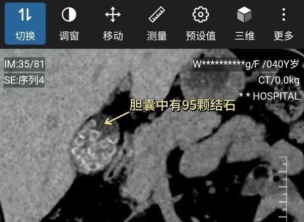 ▲▼患者体内的结石。 （图/翻摄广州日报）