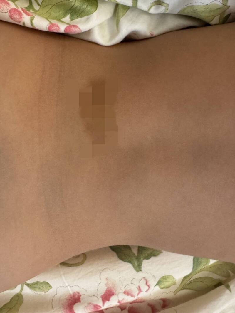 新竹市香山某私幼爆虐童,案件越滚越烈,已有10多名家长报警,且涉案教师不只1人,家长也组群组,准备集体诉讼要真相。(读者提供)
 新竹市香山某私幼爆虐童,案件越滚越烈,已有10多名家长报警,且涉案教师不只1人,家长也组群组,准备集体诉讼要真相。(读者提供)